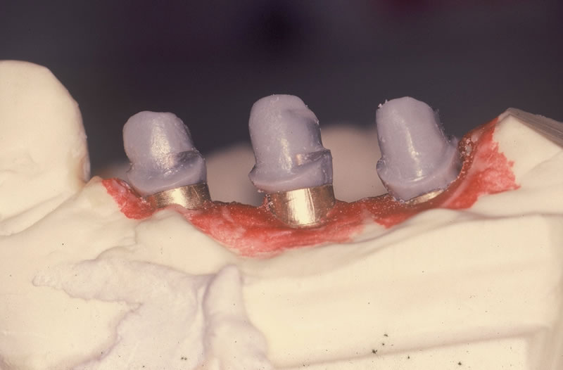 Prótesis sobre implante