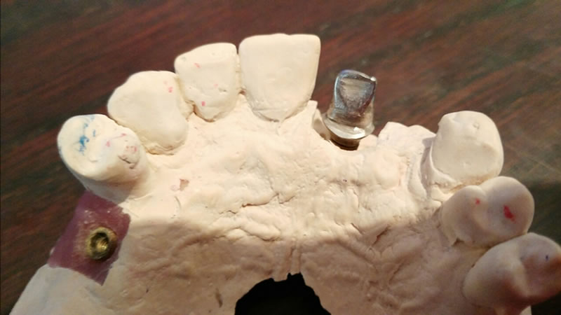 Prótesis implante